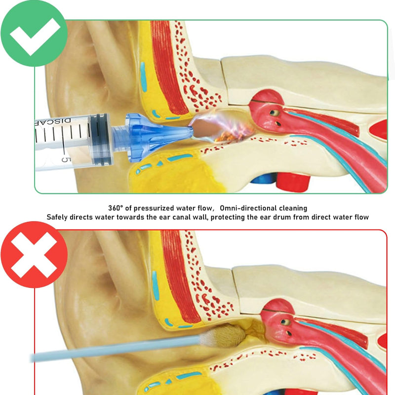 Ear Wax Cleaner Kit - Silicone Tip Syringe for All Ages